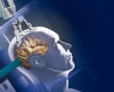 Brain Tumor Surgery